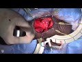 Mayo Clinic Men’s Health Moment: Penile implant abridged operative video