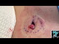 The Abscess that dressed up as a cyst for Halloween. Large deep abscess pocket on chest popped.