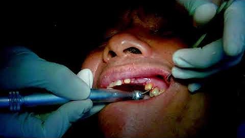 Mài cùi lấy dấu.4 răng hàm trên p1|Dr Nha Khoa Á Âu