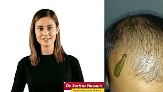 Benefits of Leech Therapy | Detox your Body | Healthistan