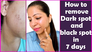 How to Remove Dark Spots & Black Spots on Face at Home in 7 days | Get Rid of Dark Spots on Face