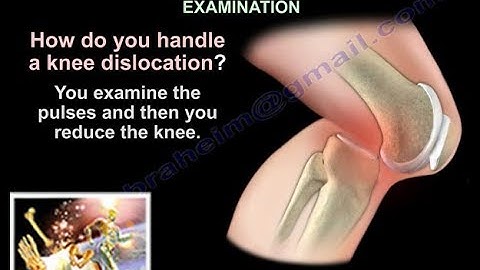Knee Dislocation - Everything You Need To Know - Dr. Nabil Ebraheim
