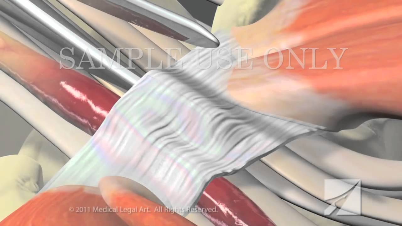 carpal tunnel syndrome surgery