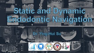 Download Lagu Static and Dynamic Endodontic Navigation (University of the Pacific Endodontic Study Club) MP3 Download Lagu Static and Dynamic Endodontic Navigation (University of the Pacific Endodontic Study Club) MP3