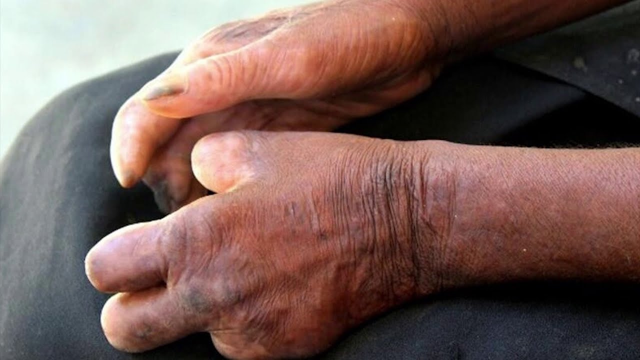 Célébration officielle de la journée mondiale des malades de la lèpre à Dimbokro