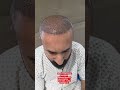 7000 grafts transformation Chinese method hair transplant result 💯Full head coverage #hairtransplant