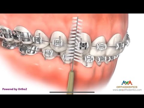 تعرف افضل طريقة لتنظيف تقويم الاسنان سهلة ومضمونه ١٠٠
