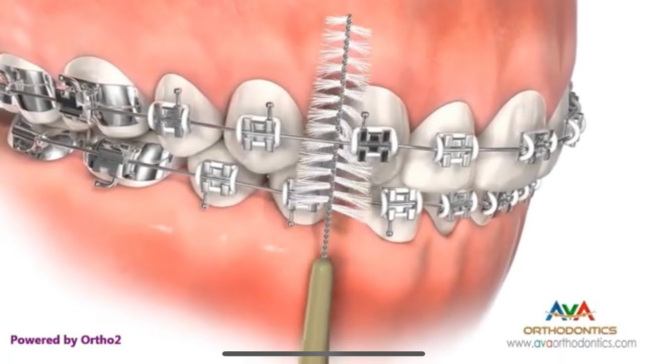 تعرف افضل طريقة لتنظيف تقويم الاسنان سهلة ومضمونه ١٠٠٪؜ 👌