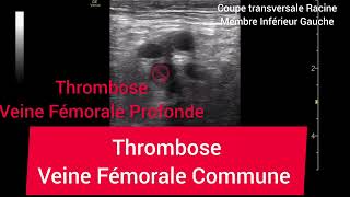 Thrombose Veineuse Profonde Veine Fémorale Commune Échographie Deep Vein Thrombosis