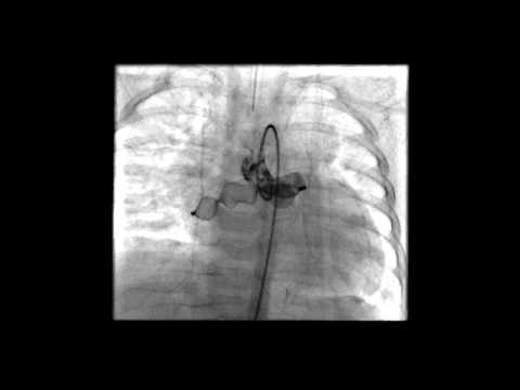Transcatheter occlusion of a coronary cameral fistula with Amplatzer Vascular Plug II