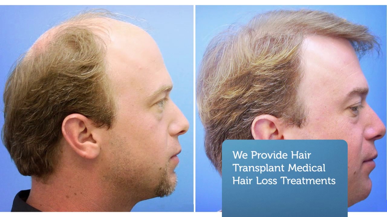 Revive Hair Transplant in Atlanta, GA YouTube