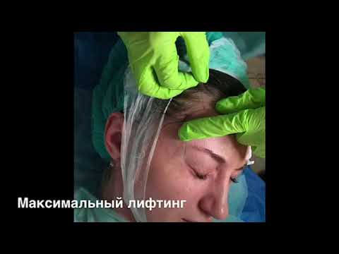 Подтяжка бровей