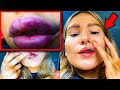 This girl's lip almost fell off her face after surgery..