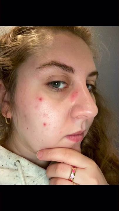 The best skincare products for cystic acne | good light