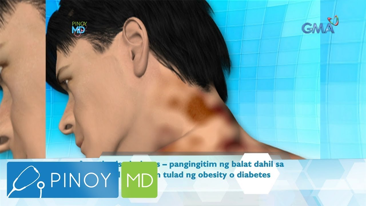 Pinoy MD: Choco na batok, ano ang solusyon? - YouTube