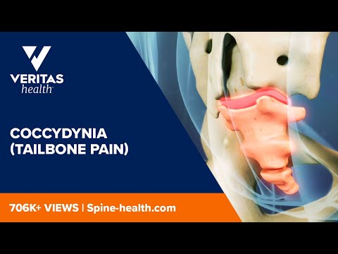 Video: Coccydynia hudumu kwa muda gani?