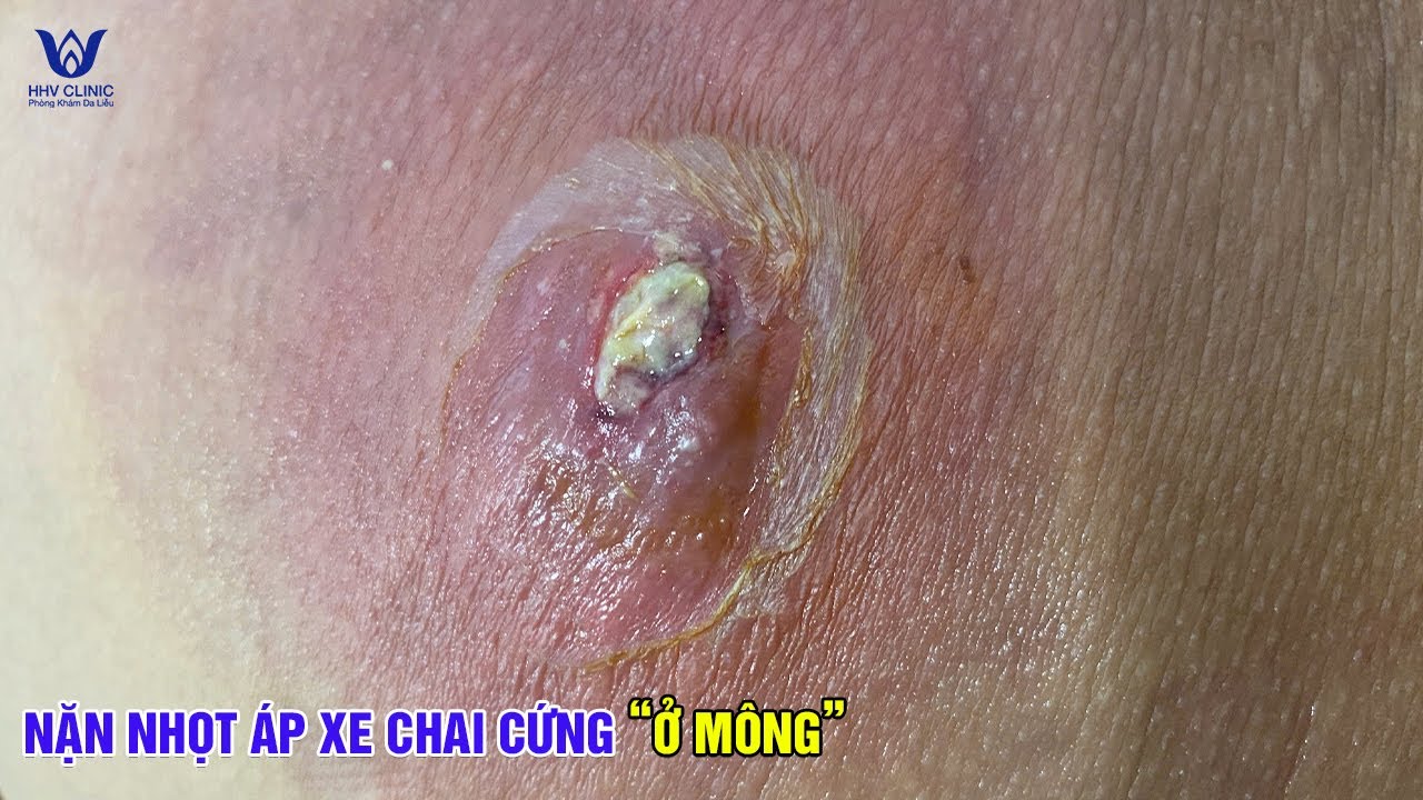 Áp xe vùng mông sưng to nhiều ngày vỡ mủ nhìn là rùng mình.