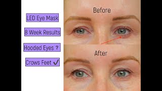 LED Eye Perfector Mask - Before & After Photos - 2 Months