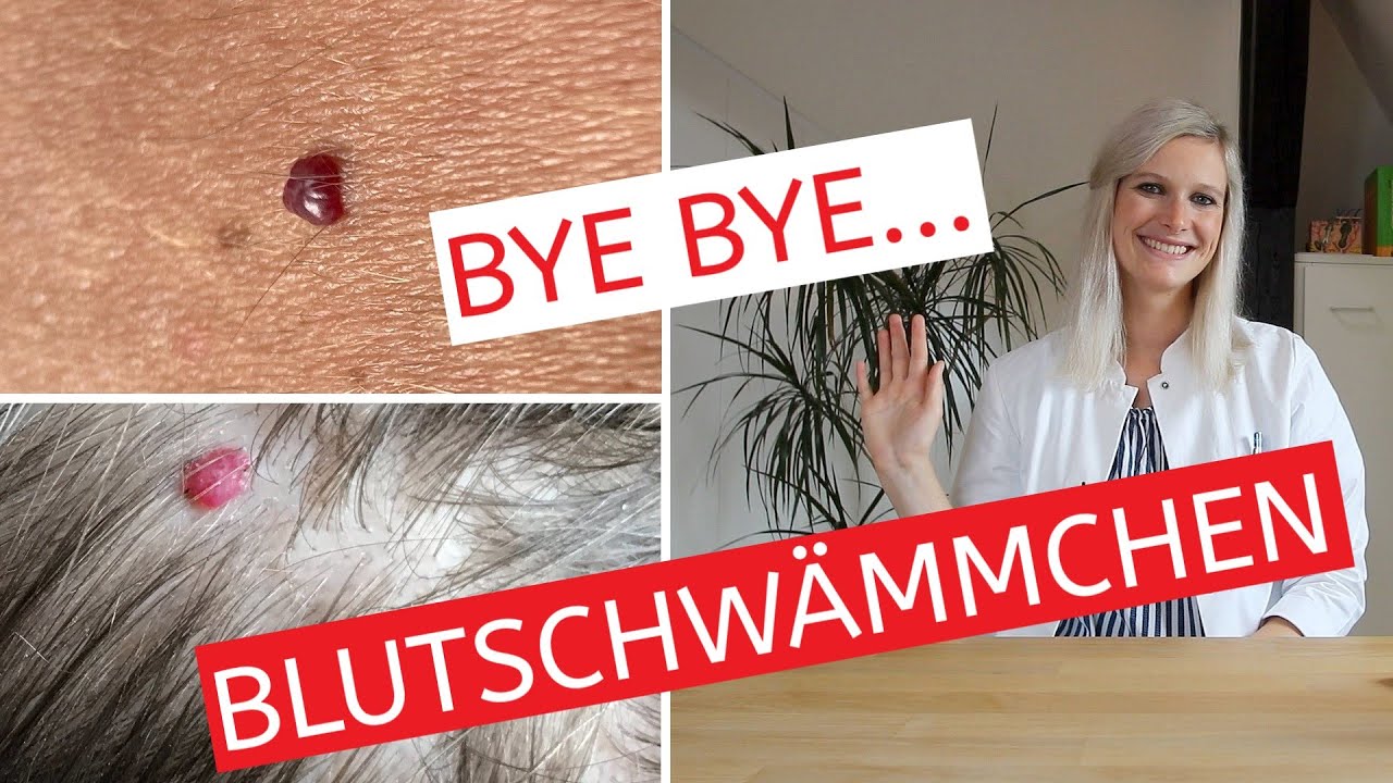 Blutschwämmchen dauerhaft entfernen effektive Methoden und Therapie narbenfreie Entfernung Blutschwämmchen dauerhaft entfernen effektive Methoden und Therapie narbenfreie Entfernung