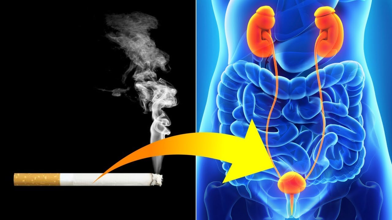 Shocking Link Between "Smoking & Bladder Cancer" YouTube