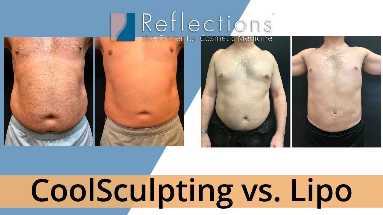 CoolSculpting vs. Lipo: Which is Better? [Price, Downtime, Pain