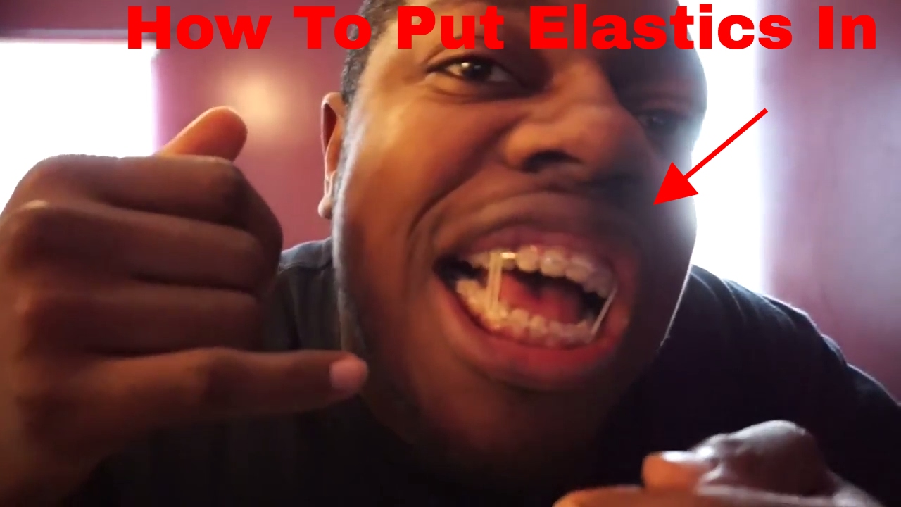 HOW TO Put Elastics/Bands In For Braces Feat. My Secret Twin YouTube