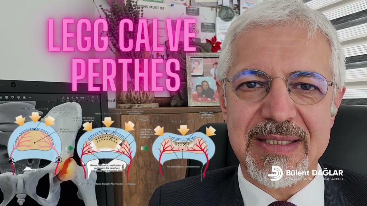 Legg calve perthes hastalığı. Legg Calve Perthes Disease. Çocuk ortopedisi