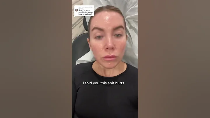 Skin Tightening After Morpheus8 Treatment #beauty #skincare #shorts