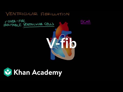 वेंट्रिकल फ़िबिलीशन (Vfib) क्या है? | संचार प्रणाली और रोग | एनसीएलईएक्स-आरएन | खान अकादमी