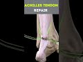 Achilles Tendon Surgery: How It’s Repaired! 😳 #AchillesTendon #surgeryexplained