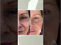 Non-Surgical Eyelid Lift with NeoGen Plasma | Eye Rejuvenation Explained