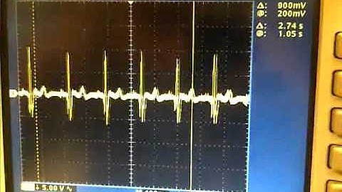 Final ECG Video with Eric