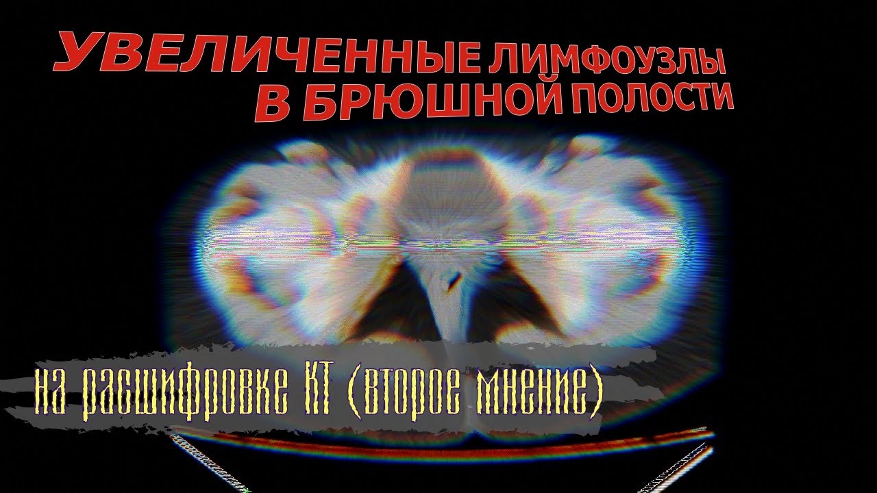 УВЕЛИЧЕННЫЕ ЛИМФОУЗЛЫ в брюшной полости и признаки ПОДЖЕЛУДОЧНОЙ ЖЕЛЕЗЫ ВОСПАЛЕНИЯ на КТ расшифровке