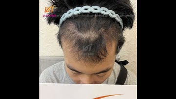 [3 tháng 14 ngày] Tóc mọc lên khỏe, đẹp, tự nhiên sau cấy tóc tự thân | Dr Duy Thành
