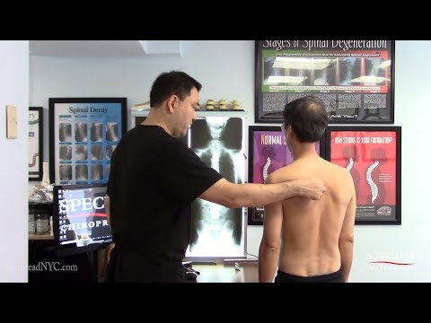Costochondritis, Rib pain, chest pain HELPED by Dr Suh Gonstead Chiropractic