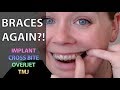 Braces: Everything you Need to Know