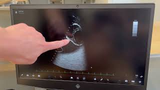 Cardiac Ultrasound: Hand & Probe Positioning