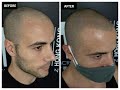 Scalp Micropigmentation (SMP) in Hong Kong. Luigi&#39;s story after 2 years