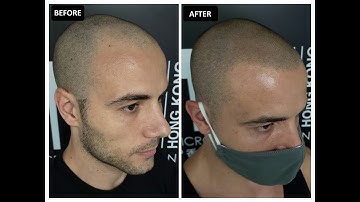 Scalp Micropigmentation (SMP) in Hong Kong. Luigi
