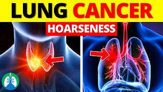 Is Hoarseness a Sign of Lung Cancer ❓ by Respiratory Therapy Zone 1,909 views 1 month ago 3 minutes, 14 seconds