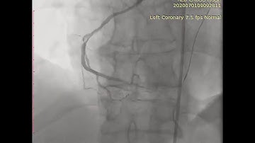 RCA CTO during total revascularization