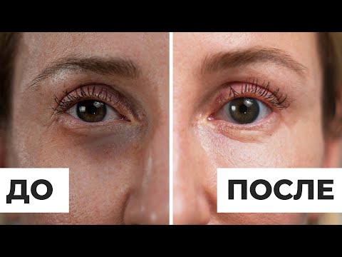 ПРИЧИНЫ появления темных кругов под глазами. Как избавиться от СИНЯКОВ в области вокруг глаз?