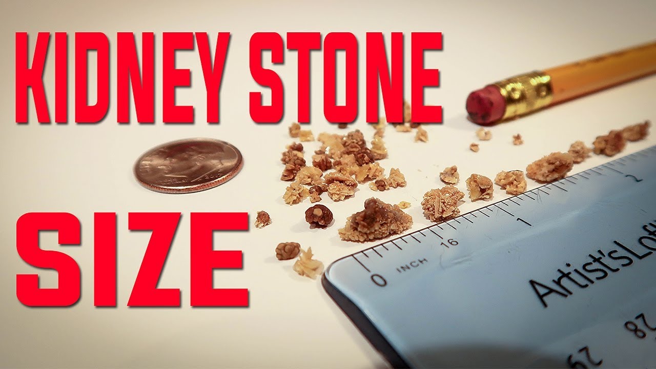 Kidney Stone Size You Can Pass At Home