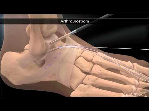 Bandrekonstruktion bei chronischer Instabilität des Sprunggelenkes - Arthroscopic Broström