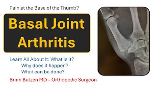 Thumb Arthritis: Hand Surgeon Explains!