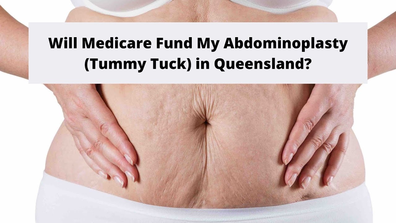 will-medicare-cover-my-abdominoplasty-tummy-tuck-in-queensland-youtube