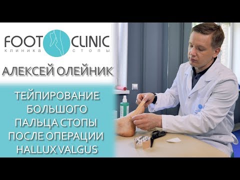 Hallux Valgus реабилитация. Тейпирование 1-го пальца.