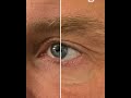 Poche malaire : le traitement chirurgical explained | Dr Hayot Paris