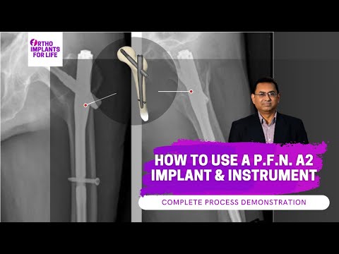 How To Use P.F.N A2 Implant and