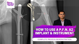 How To Use Pfn A2 Implant And Instrument